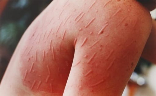 Tratamentele cosmetice potrivite daca ai dermografism