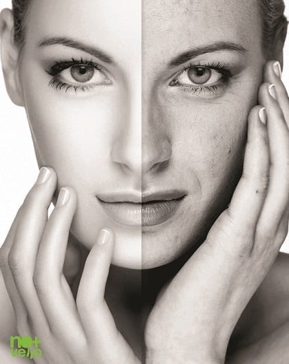 Rejuvenarea faciala Nomasvello trateaza ridurile, petele, acneea Rejuvenarea faciala Nomasvello trateaza ridurile, petele, acneea
