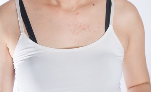 foliculita_cauze_sim_a9mLu foliculita_cauze_sim_a9mLu