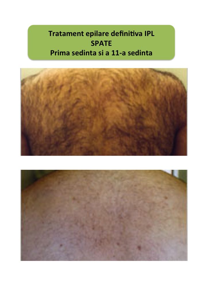 Epilare definitiva barbati (2)