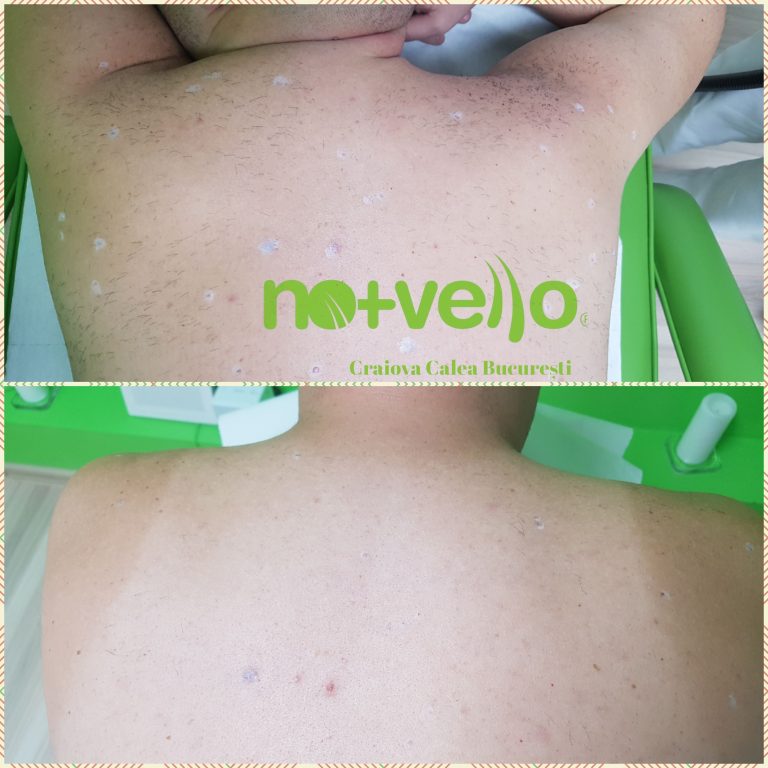 Epilare definitiva spate