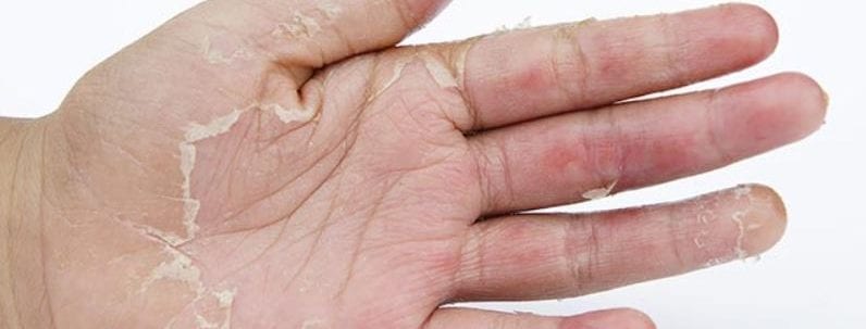 Îngrijirea mâinilor uscate și crăpate: Tot ce trebuie să știi