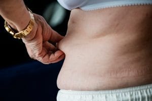 Femeie trăgând de excesul de grăsime de pe șolduri, evidențiind celulita
